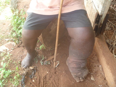 A lymphatic filariasis sufferer in Nigeria