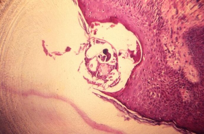 Photomicrograph of scabies burrowed into skin tissue. Credit CDC Public Health Image Library