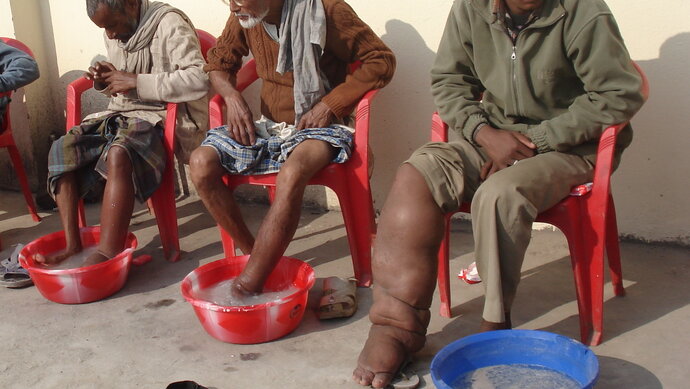 Lymphatic filariasis sufferers. Photo courtesy of LCNTD