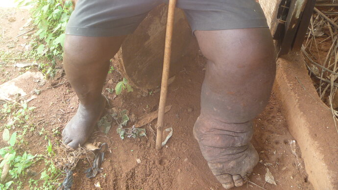 A lymphatic filariasis sufferer in Nigeria