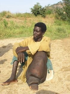 Elephantiasis is a debilitating condition that can result from LF infection. Image courtesy of the Carter Centre.