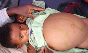 A girl in Libo Kemkem district, Ethiopia, displays the classic markers of visceral leishmaniasis, liver and spleen enlargement. Photograph: World Health Organisation