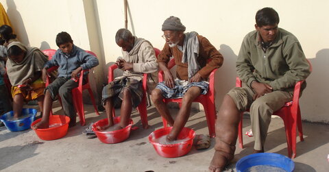 NTDs such as Lymphatic filariasis profoundly disable sufferers abilities to live normal lives. Photo courtesy of LCNTD