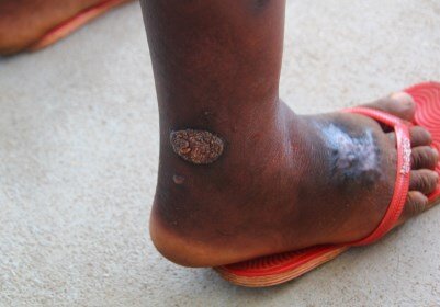 A suspected case of yaws identified during case finding activities. Image courtesy LASER, LSHTM